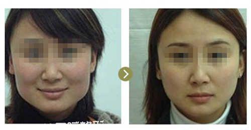 去眼尾纹注射糖醛酸最佳或者是去皱针为好?安全吗?